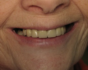Smile after dental bridge procedure