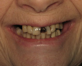 Smile before dental bridge procedure.