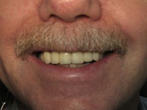 Smile after dental bridge procedure.
