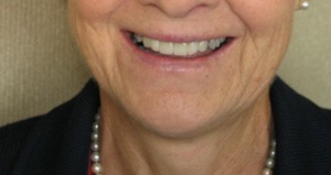 Smile after cosmetic dental procedure.