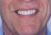 Smile after dental crown procedure