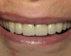 Smile after dental crown procedure