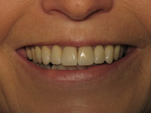 Smile after dental crown procedure.