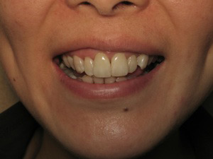 Smile after dental crown procedure.