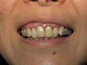 Smile before dental crown procedure.