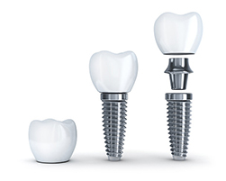 Image of a dental implant, at Capital Dental Center in Washington, DC.