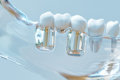 Image of a couple of dental implants inside of a glass jaw model, at Capital Dental Center in Washington, DC.