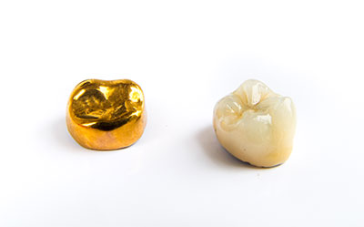 Image of a gold tooth and a porcelain crown.
