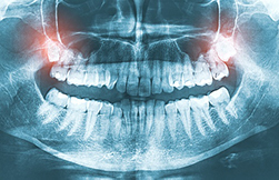 X-ray image of wisdom teeth at Capital Dental Center.